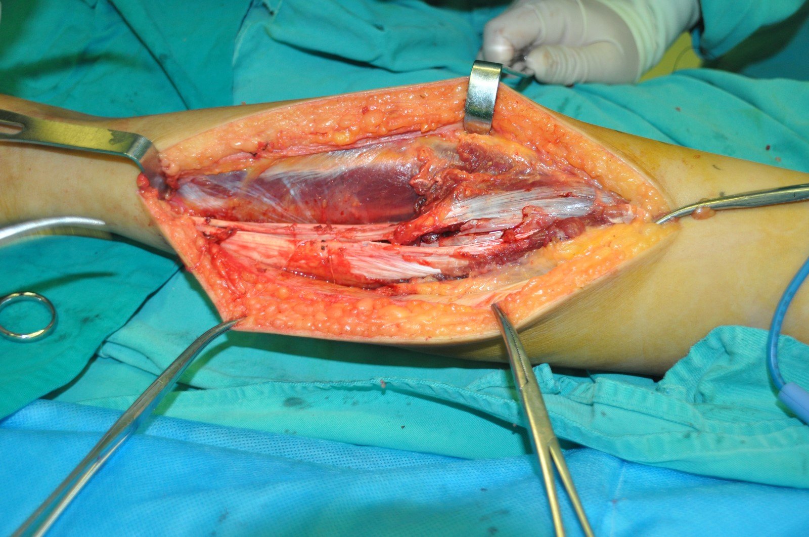 腿部手术小游戏攻略(腿部手术7k7k小游戏)